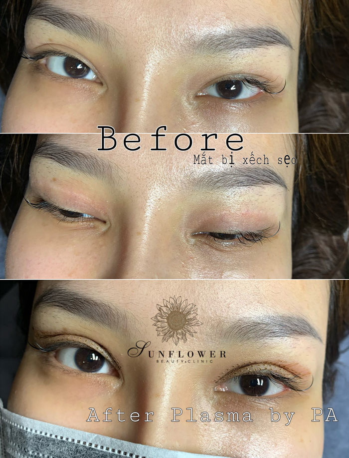 Hình ảnh một khách hàng đã tin tưởng điều trị tại Sunflower Beauty & Clinic