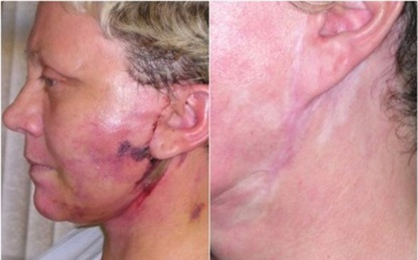 Hình ảnh thực tế khách sưng tấy và để lại nhiều biến chứng sau căng chỉ