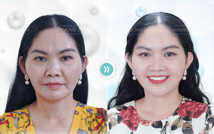 Nhận thức sai lệch về công nghệ 'căng chỉ' trong định nghĩa 'trẻ hoá' Ảnh 2