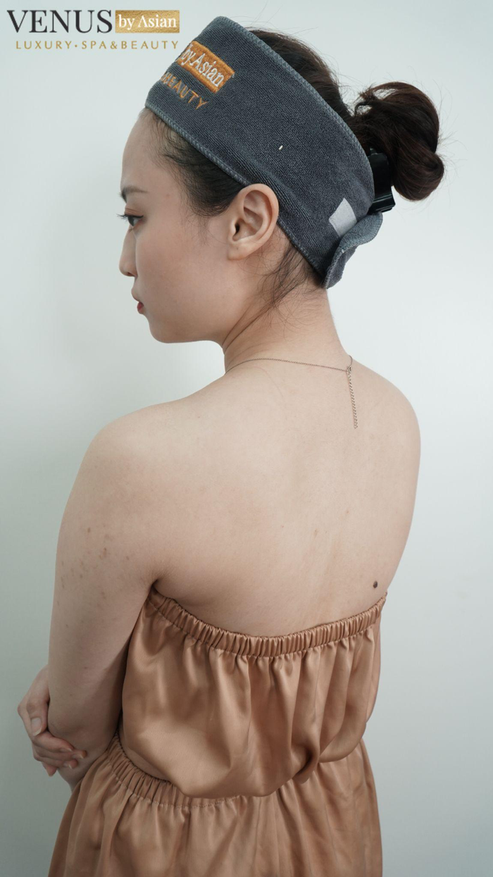 Viêm da dầu gây ra sự khó chịu cho chị Hạnh trong thời gian dài