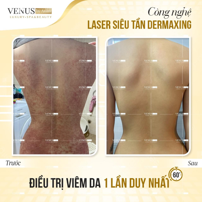 Hình ảnh vùng viêm da dầu của khách hàng trước và sau điều trị bằng công nghệ cao 