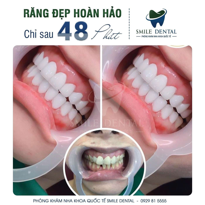 Nhiều ưu đãi hấp dẫn sẽ diễn ra nhân dịp khai trương chi nhánh mới của Smile Dental.