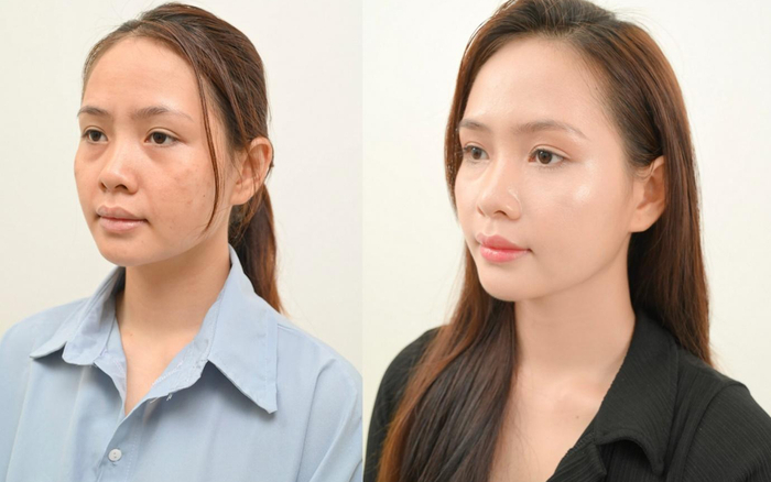 Phương pháp giúp làn da căng bóng mà không can thiệp phẩu thuật Ảnh 2