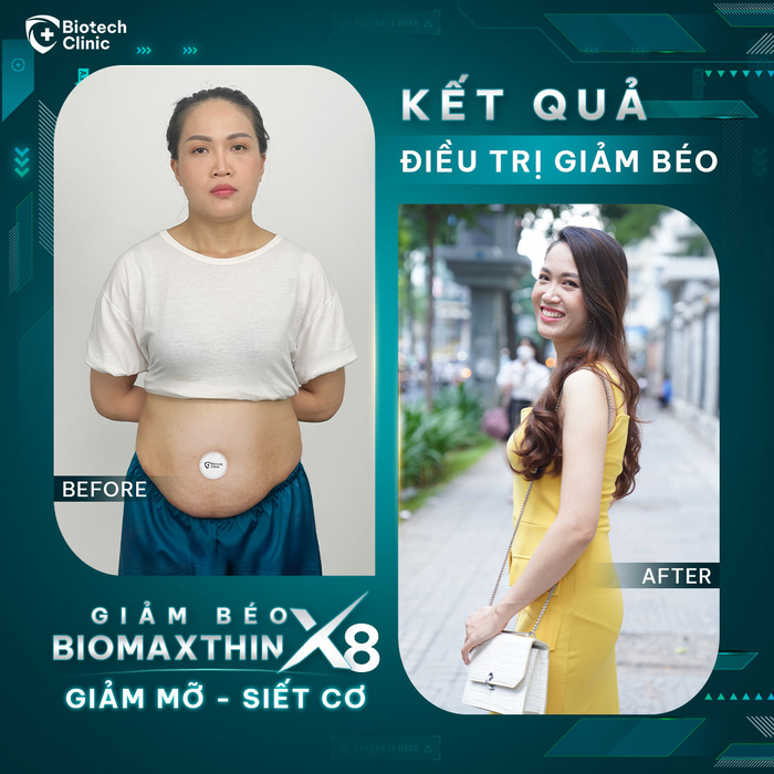 Vòng eo gọn gàng, săn chắc không chút mỡ thừa của chị Phương sau khi thực hiện Giảm béo BioMaxthin