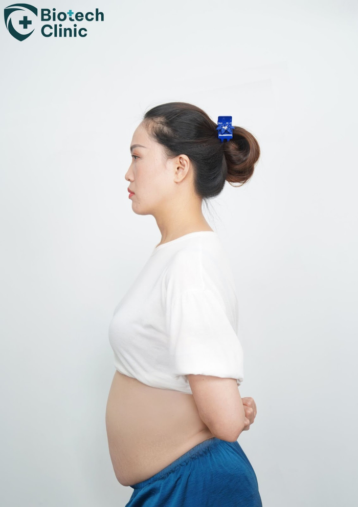 Thân hình to béo, vòng eo ngấn mỡ khiến chị Phương đi lại khó khăn, lỡ dở công việc