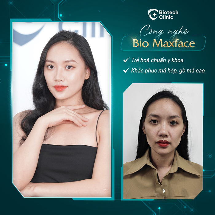 Hình ảnh trước và sau khi chị Nga thực hiện xong công nghệ Mô sinh học Bio MaxFace