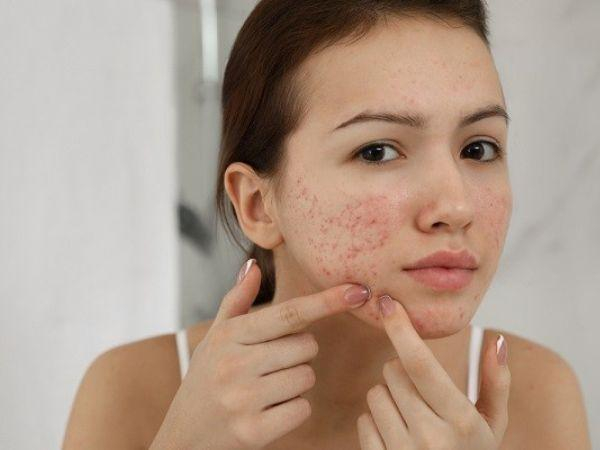 Mụn viêm gây mất thẩm mỹ trên gương mặt