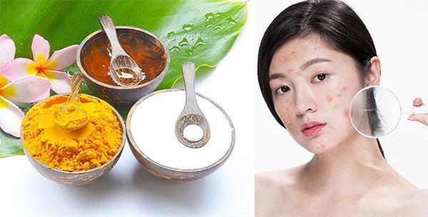 Làm xẹp mụn viêm từ các nguyên liệu tự nhiên
