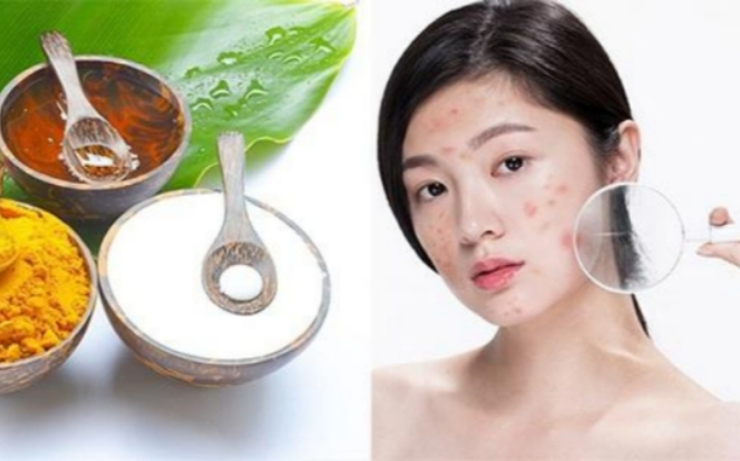 Bí kíp xử lý mụn viêm và thâm mụn nhanh gọn, hiệu quả tại nhà! Ảnh 2