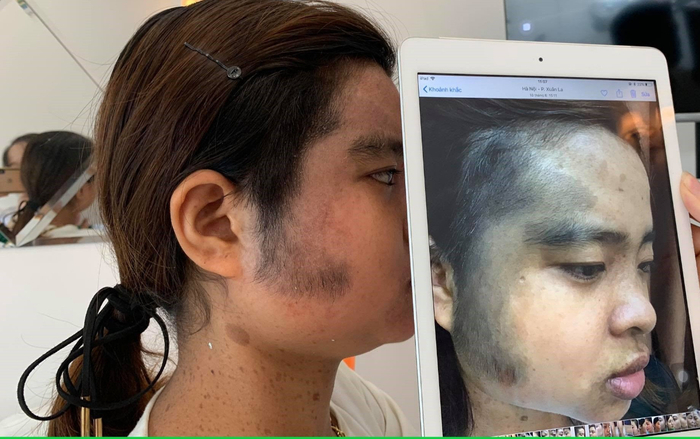 Chữa chàm mặt thành công diện mạo thay đổi bất ngờ Ảnh 2