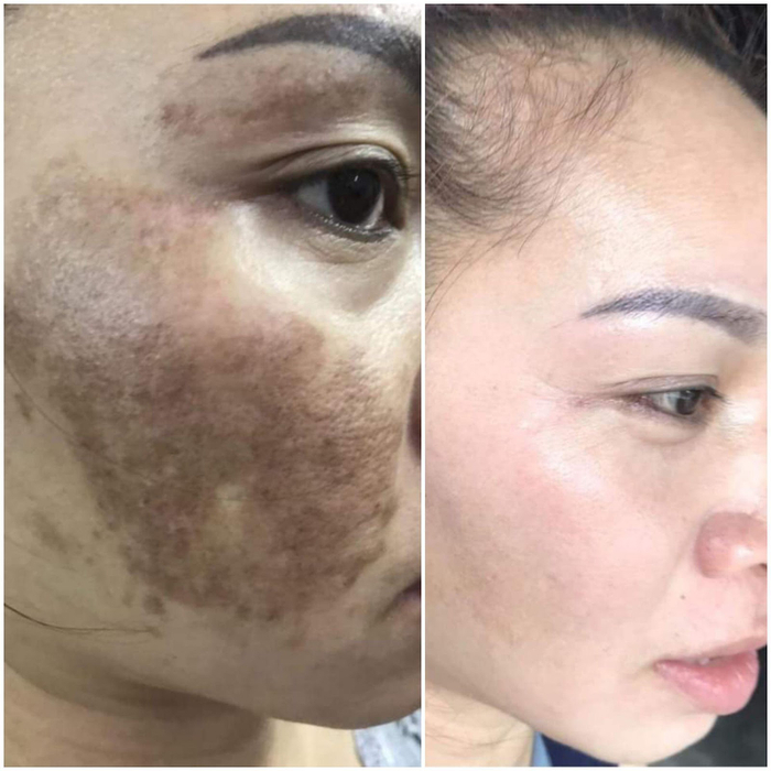 Chàm - một dạng rối loạn sắc tố da