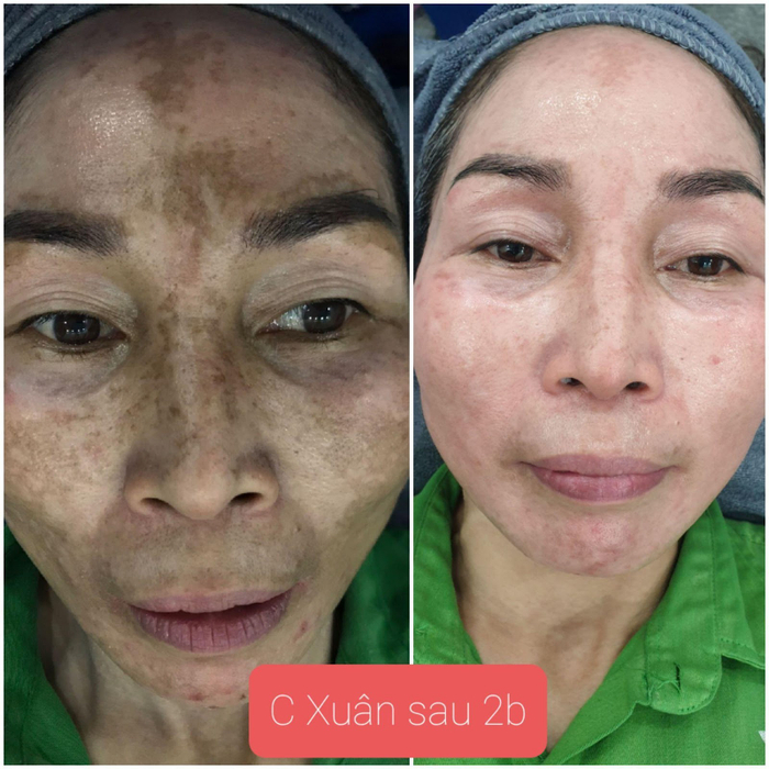 Cô Xuân sau 2 buổi điều trị tại Viện thẩm mỹ Quốc tế Harry