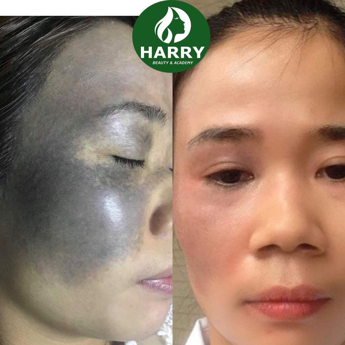 Kết quả điều trị chàm thành công bằng công nghệ mới