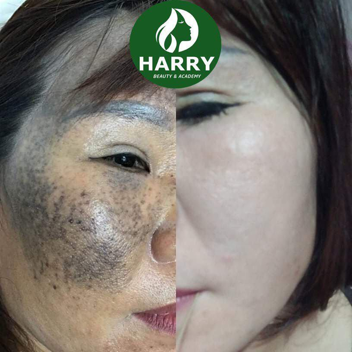 Khách hàng trị chàm thành công tại Harry