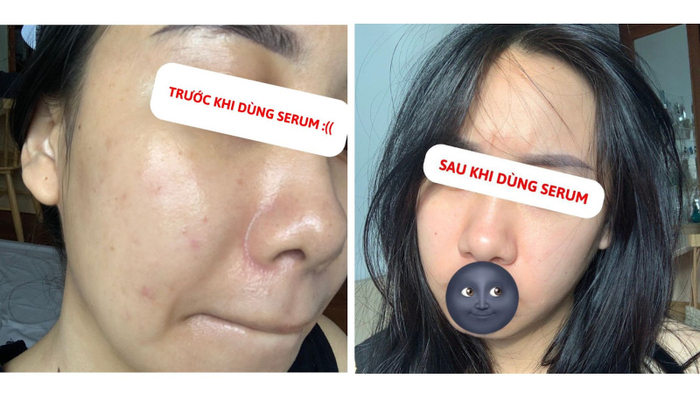 Hội chị em mê làm đẹp trầm trồ vì serum mỹ phẩm Việt đánh bay mụn dậy thì chỉ sau 2 tuần Ảnh 1