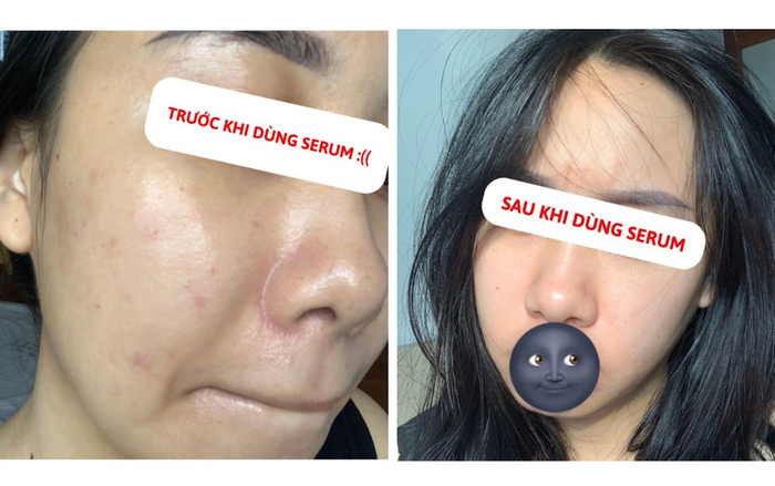 Hội chị em mê làm đẹp trầm trồ vì serum mỹ phẩm Việt đánh bay mụn dậy thì chỉ sau 2 tuần Ảnh 2