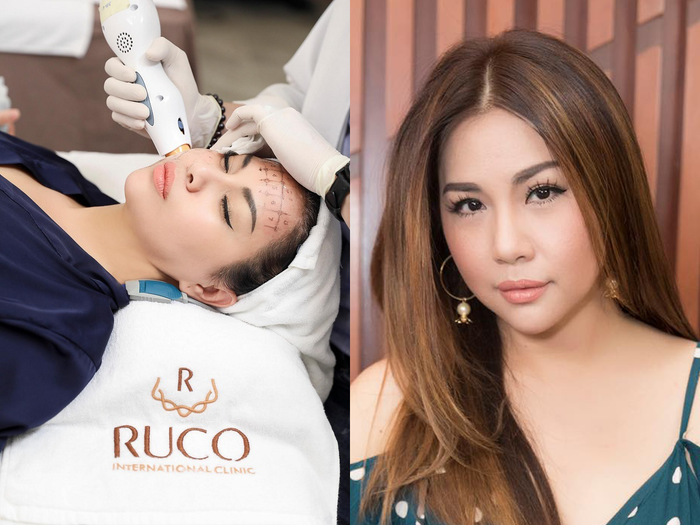 Minh Tuyết vẫn giữ được nhan sắc như thiếu nữ nhờ vào liệu trình căng da, xóa nhăn bằng công nghệ Thermage từ Hoa Kỳ