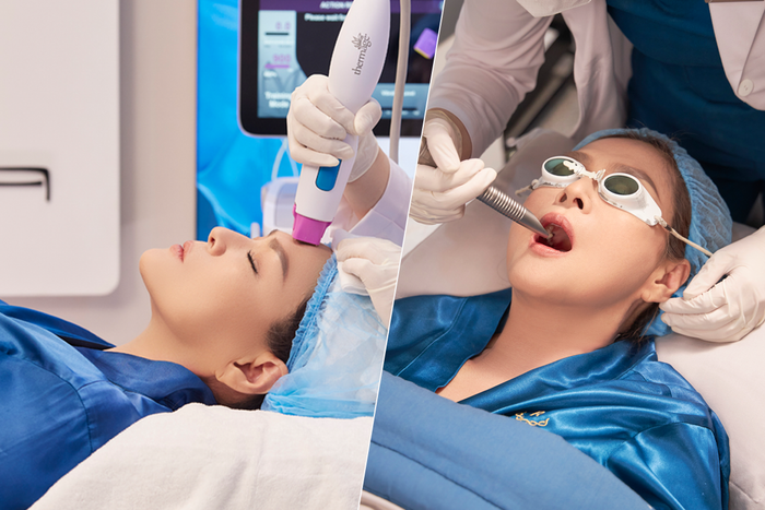 Lưu Bích đang trong quá trình điều trị bằng công nghệ căng da, xóa rãnh cười Thermage X3 với sự kết hợp giữa Thermage FLX (Mỹ) & Magic Lifting 4D (Đức) tại Ruco International Clinic