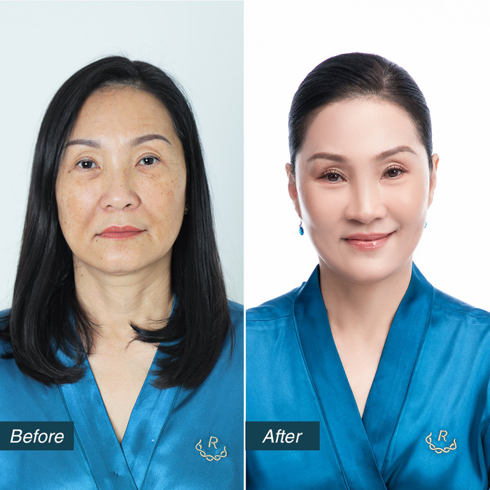 Nhờ sự can thiệp của công nghệ căng da, xóa nhăn Thermage và nâng cơ, trẻ hóa Ultherapy tại Ruco, Hồng Đào U60 vẫn giữ được làn da tươi trẻ, căng mịn