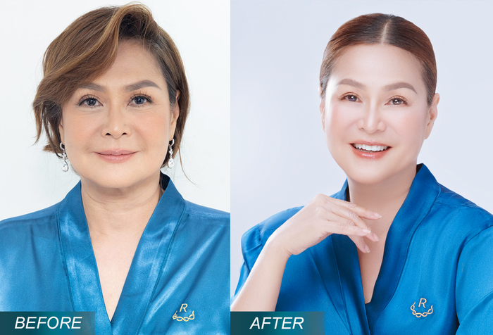 Ngẩn ngơ trước nhan sắc mặn mà, xinh đẹp của Lưu Bích sau 1 liệu trình điều trị