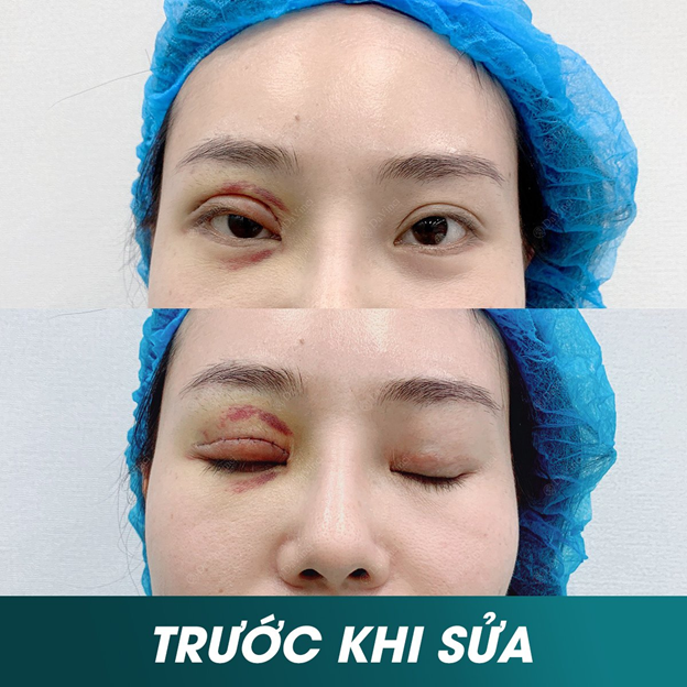 Tình trạng cắt mí hỏng của bạn M.N trước khi được sửa lại thành công.
