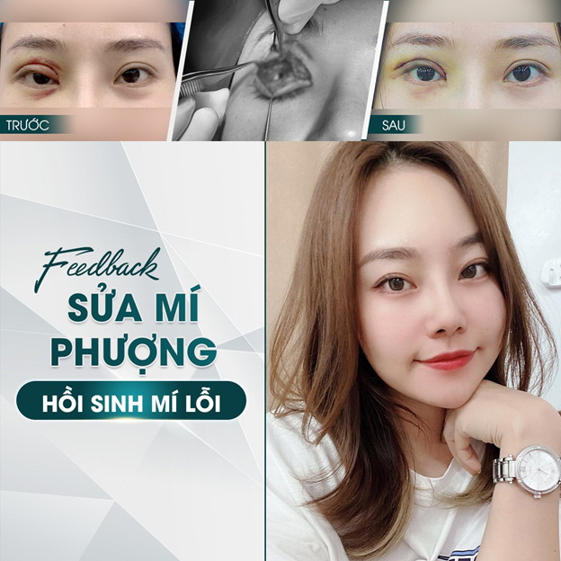 Hình ảnh trước & sau khi sửa mí của bạn L.T.Q do Ekip BS Trần Sinh Lục thực hiện.