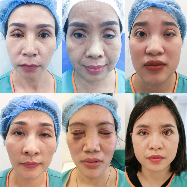Một số ca Mí hỏng sau khi thực hiện tại các Spa cỏ