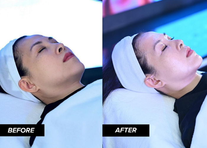 Sự khác biệt trên làn da người mẫu trước và sau khi thực hiện liệu trình Glassy Glow Solution