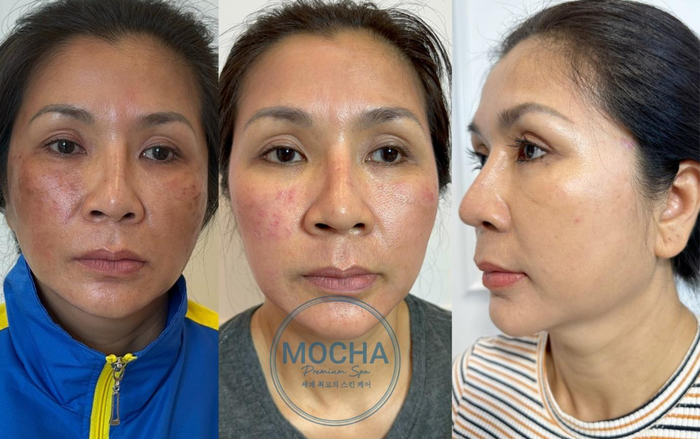 Làm đẹp không khó với top 3 dòng sản phẩm Retinol mix Peel Mocha Ảnh 2
