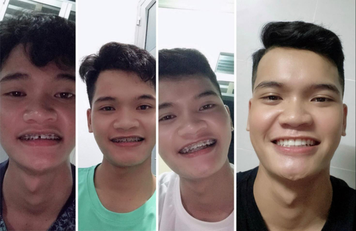 Niềng răng – khoản đầu tư khôn ngoan cho sức khỏe và vẻ ngoài của bạn Ảnh 5