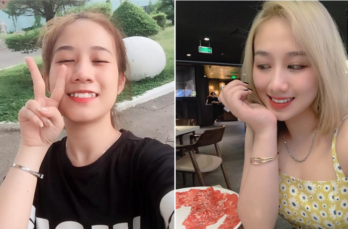 Bạn Mỹ sau khi niềng răng cải thiện diện mạo, tăng sự tự tin – khoản đầu tư xứng đáng