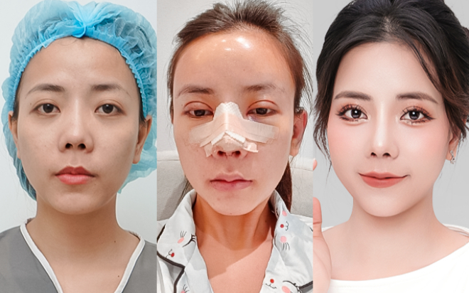 2023 cô nàng 9x già hơn tuổi thật 'Lột Xác' nhan sắc sau phẫu thuật thẩm mỹ Ảnh 2