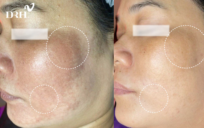 DRH Clinic và câu chuyện điều trị nám biến chứng! Ảnh 2