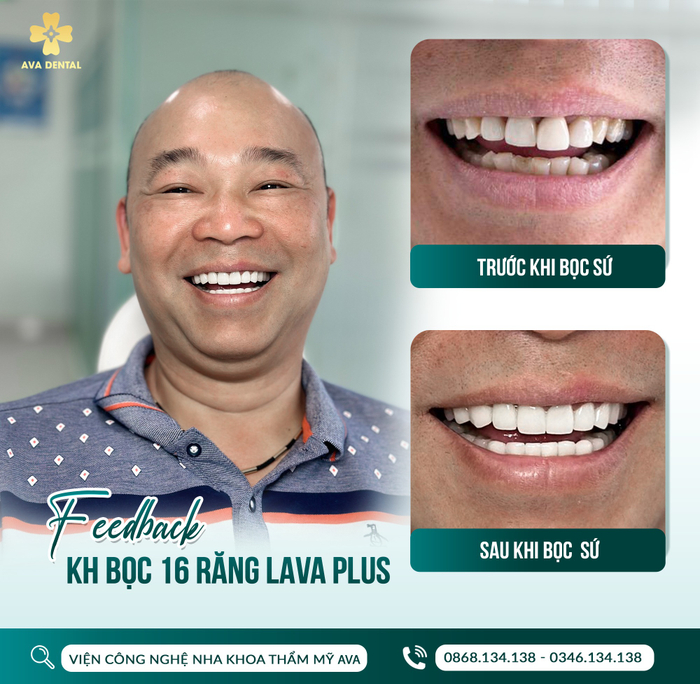Khách hàng bọc 16 răng sứ LAVA tại AVA Dental