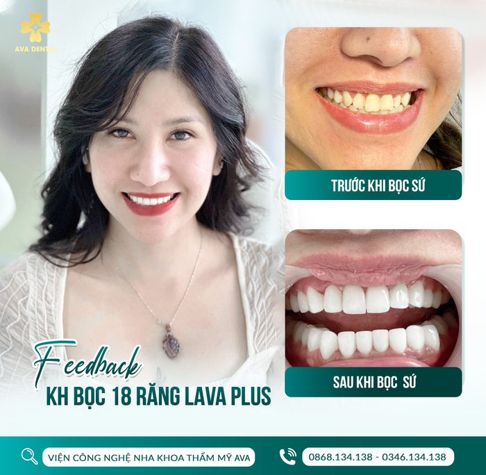 Khách hàng bọc răng sứ LAVA tại AVA Dental